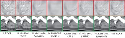 Low Dose CT Denoising by ResNet With Fused Attention Modules and Integrated Loss Functions